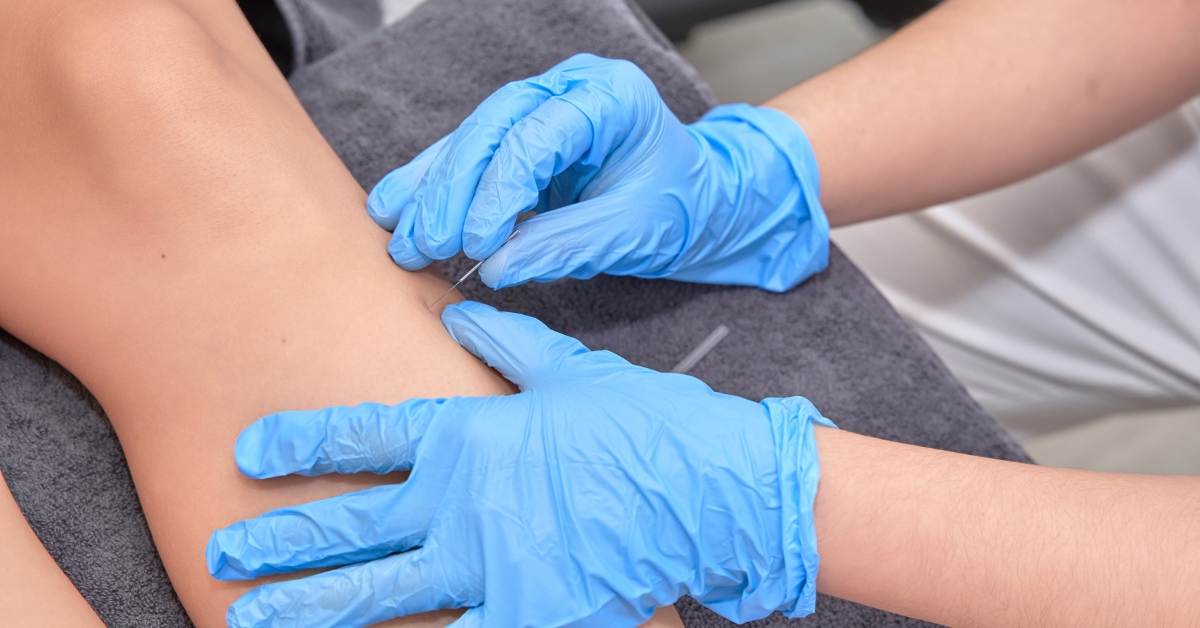 dry needling vs acupuncture