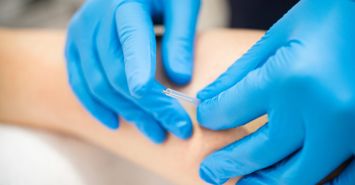 dry needling vs acupuncture